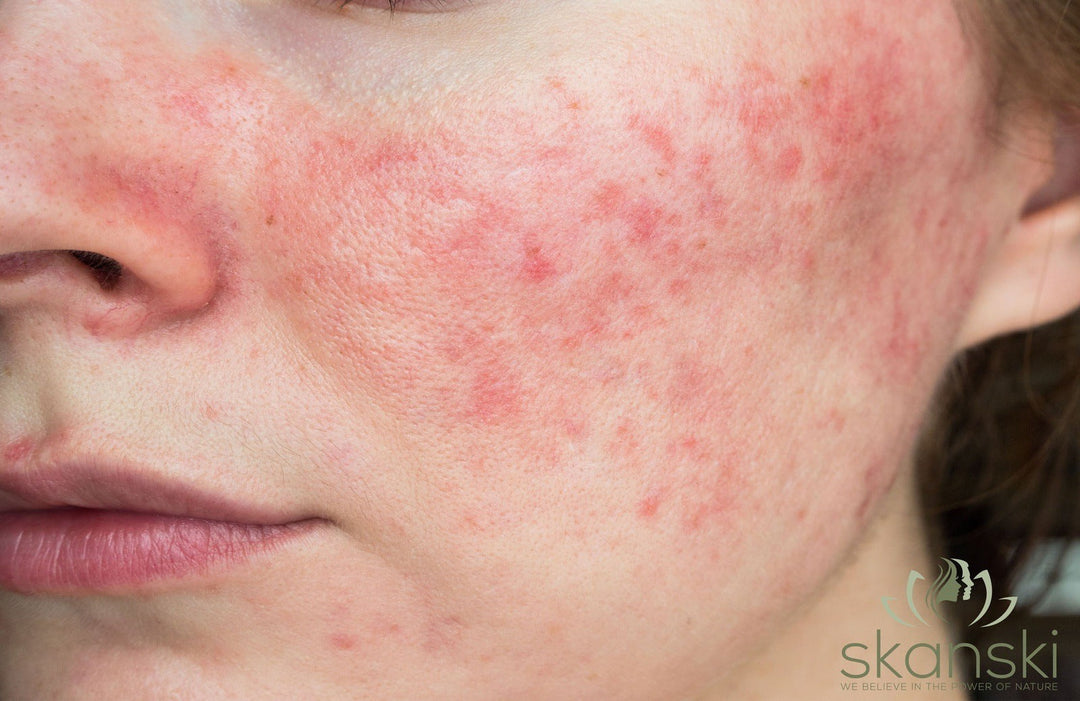 Girl with redness on her face